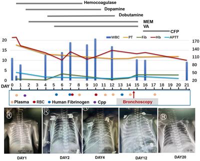 Ultra-slim flexible bronchoscopy-guided topical hemostatic drugs administration for the management of life-threatening refractory pulmonary hemorrhage in a preterm infant: Case report